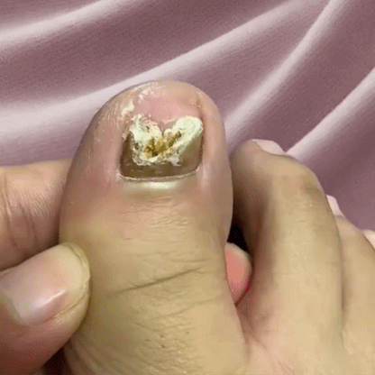 Nail Help - Plasturi Antifungici EFICIENTI